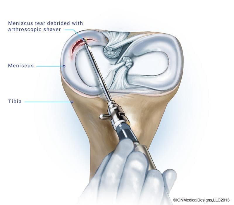 Meniscus Repair Surgery