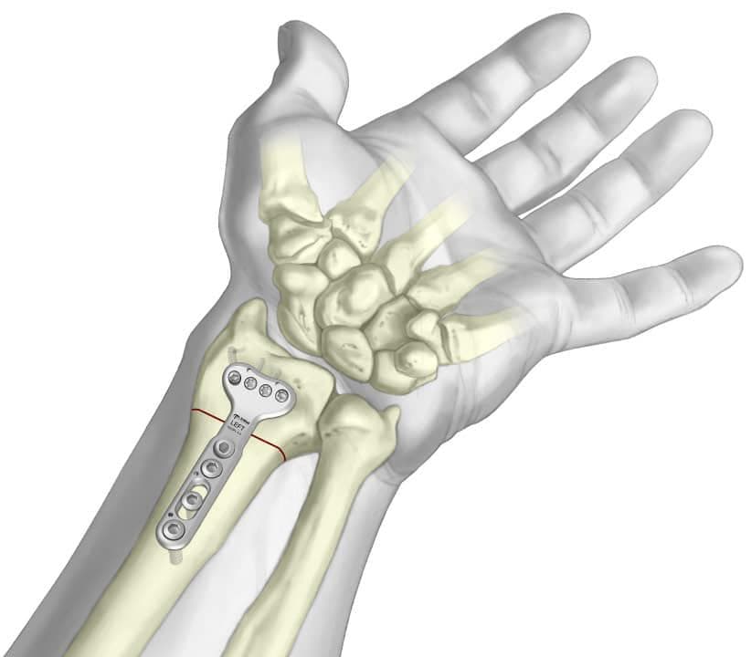 Hand & Wrist Surgery